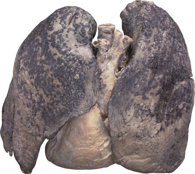 Foto dei polmoni del fumatore