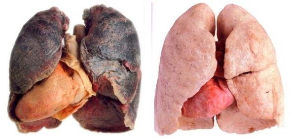 Raggi X dei polmoni del fumatore