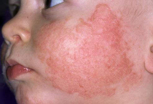 alergiju na novorođenčad na licu