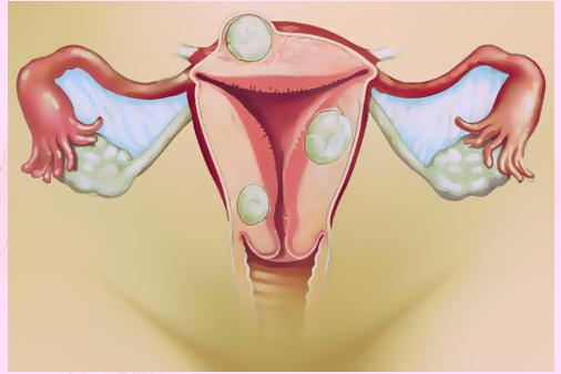 jak je léčena endometrióza