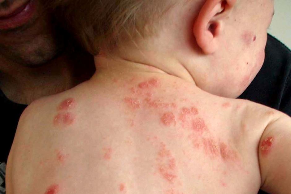 projevy alergie u malého dítěte