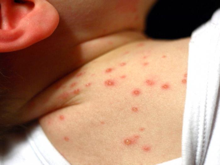 Come trattare la varicella