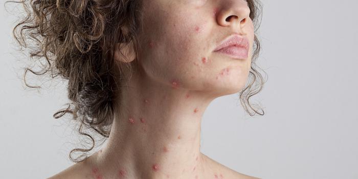 Jak se léčit neštovicemi u dospělých doma