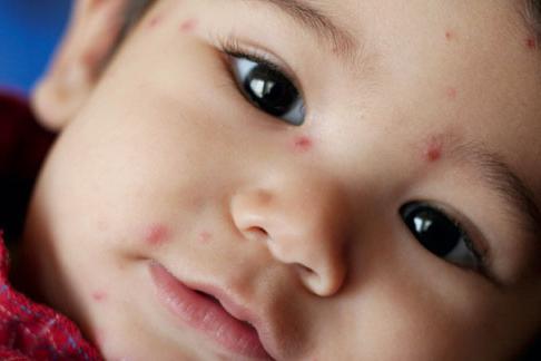 Come curare la varicella nei bambini a casa