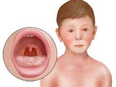 šarlatovou horečku u dětských příznaků a léčby
