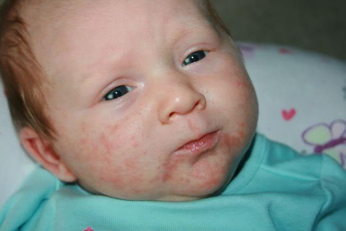 Staphylococcus aureus при бебета