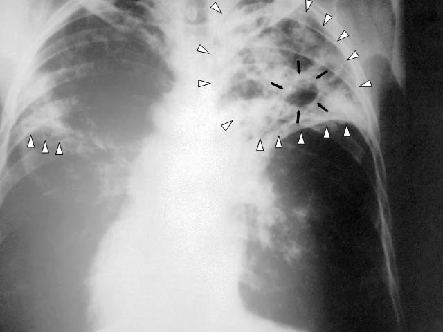 как се предава туберкулоза
