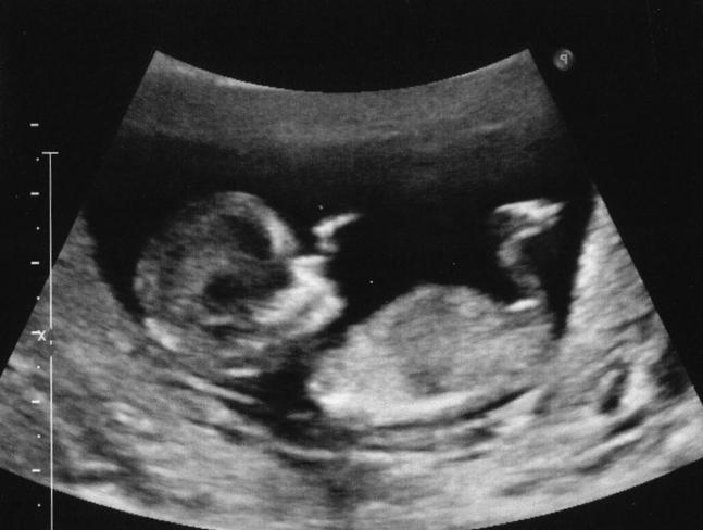 l'ecografia pelvica mostra una gravidanza