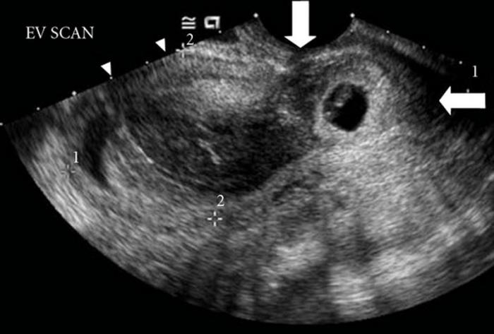 L'ecografia mostra una gravidanza ectopica?