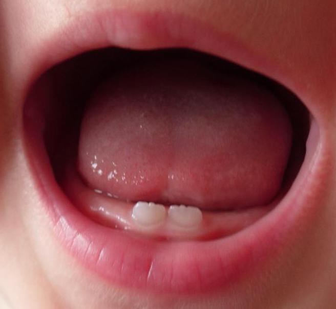 колко млечни зъби при деца 3 години