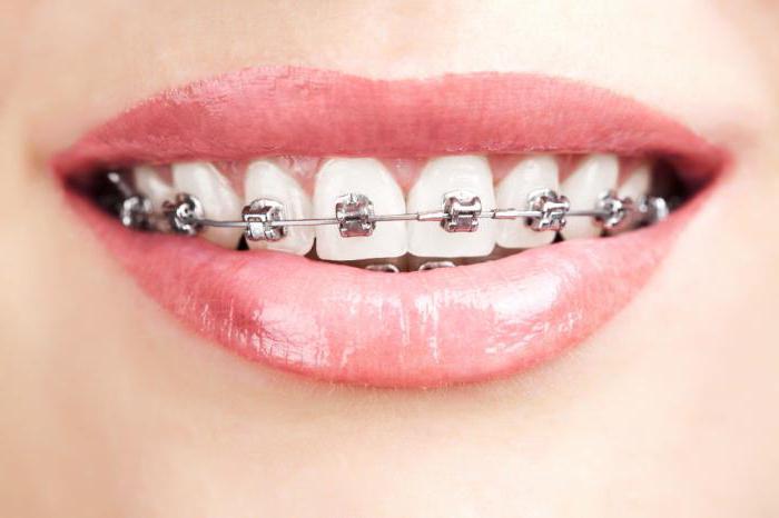 kolik potřebujete nosit zarážky pro zarovnání zubů