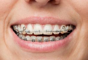 Quanto sono le parentesi sui denti
