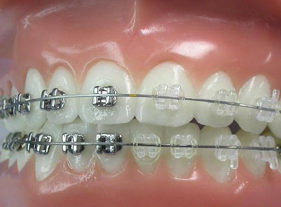 Koliko košta stavljanje proteza na zube