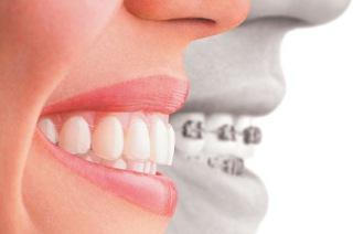 Ile mają aparaty ortodontyczne na górnych zębach