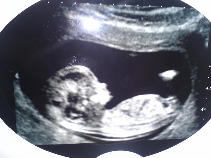 koliko lahko naredite ultrazvok med nosečnostjo