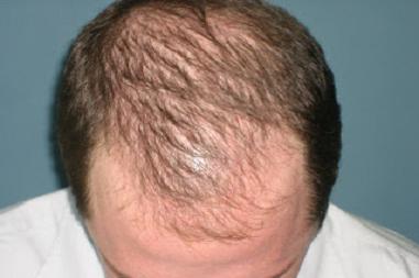 възстановяване на растежа на косата по главата