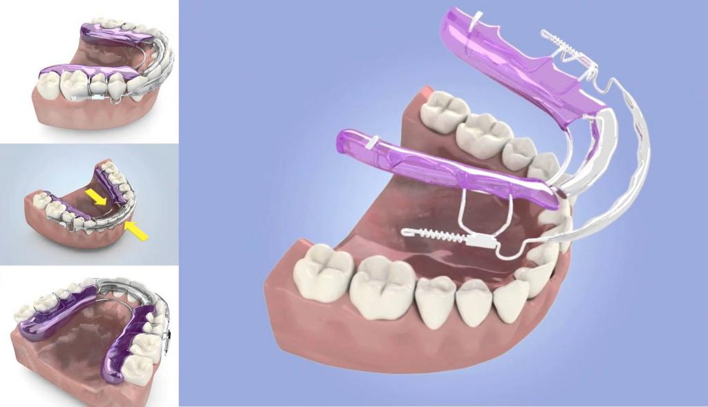 Poravnajte zube bez proteza za odrasle