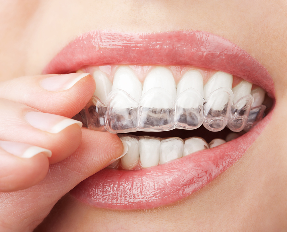Как да подравните зъбите без скоби?