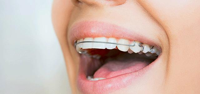 Kako hitro poravnati zobe brez naramnic?