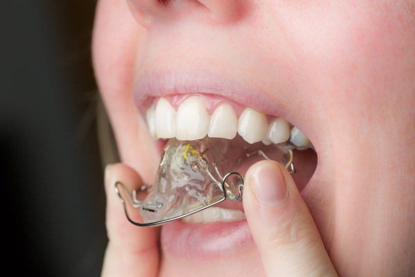 Как да подравните кривата на зъба без скоби?