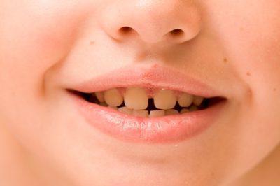 jak čistit zuby dítěte z černého náletu