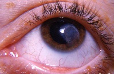 Како лечити трн у оку?