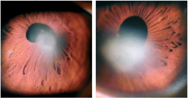 Како излијечити трн у оку?