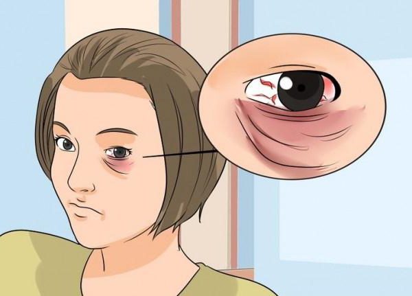 как да се прикрие синина под окото от удар