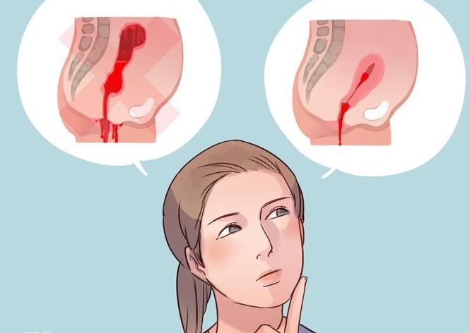 как да се различи кървенето от менструацията