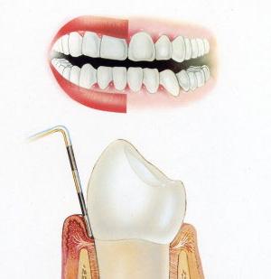 възпаление на венците, отколкото за лечение