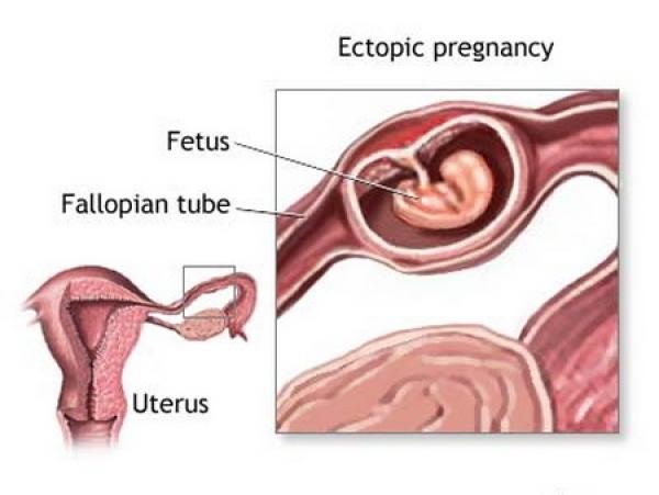 Il test mostra una gravidanza extrauterina?