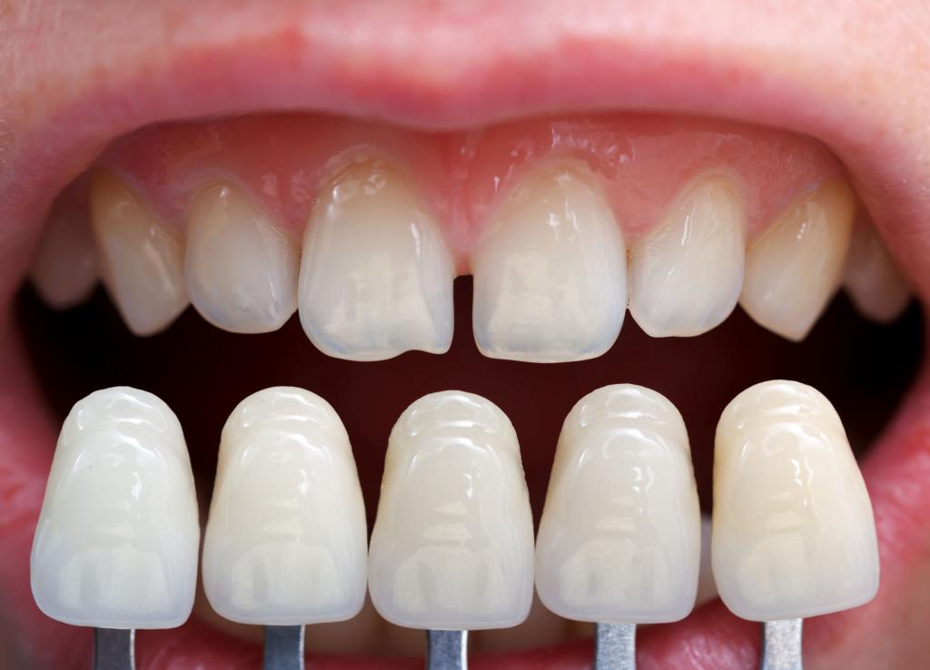 Gap mezi zuby, jak to opravit?