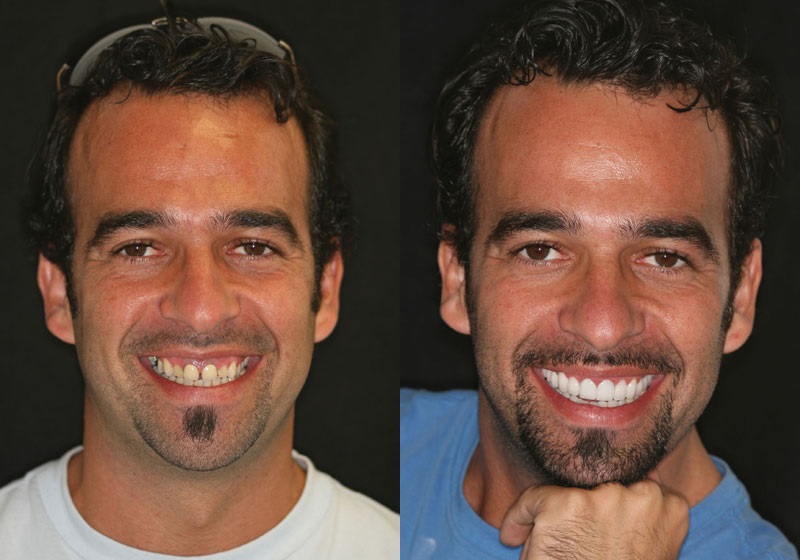 Przerwa między zębami, aparatami ortodontycznymi