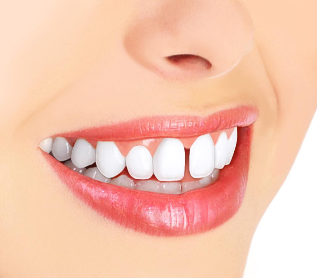 Как да се премахне разликата между предните зъби?