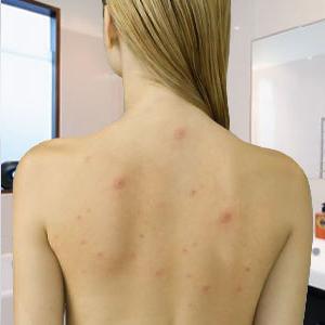 come sbarazzarsi di acne sulla schiena