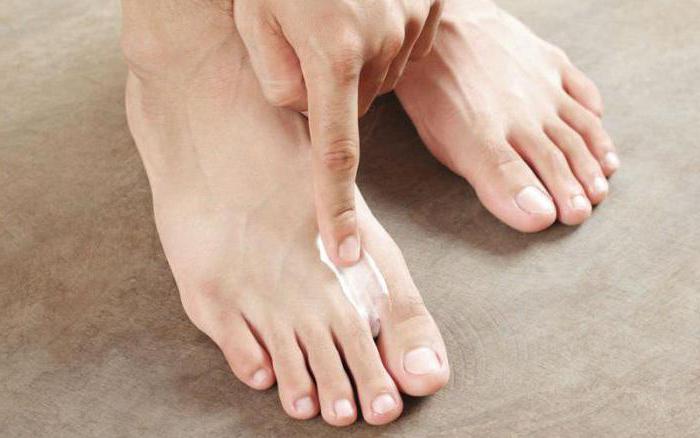 как да се отървем от гъбичките на ноктите на краката