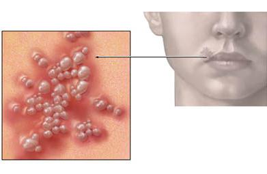 kako zdraviti prehlad na ustnici