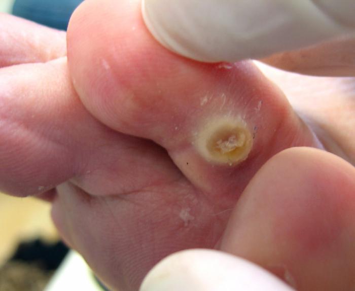 chirurgické odstranění kalusů na nohou