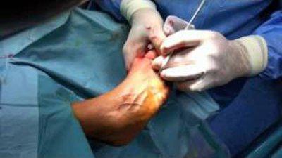 операция на кост на крака