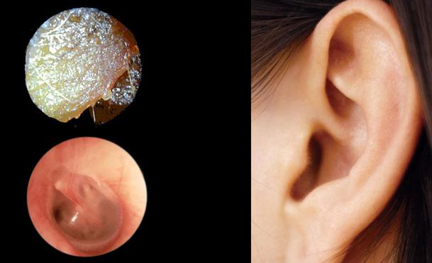 как да се отървете от тапи за уши