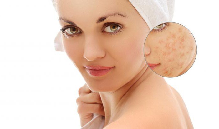 Jak se zbavit podkožního akné na obličeji