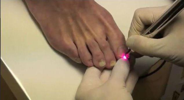 тестове за гъбички на ноктите