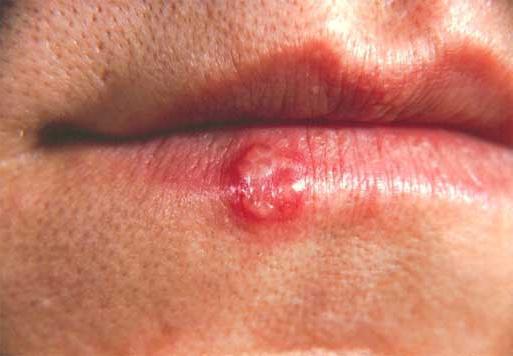 Come curare rapidamente l'herpes sulle labbra
