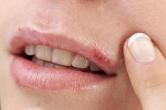 Come sbarazzarsi rapidamente dell'herpes sulle labbra