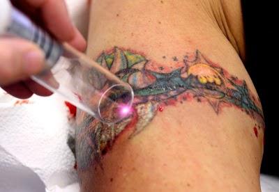 Bezbarwne usuwanie tatuaży