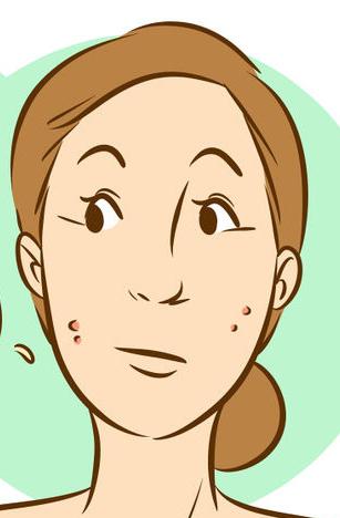 come rimuovere i rossi dell'acne a casa