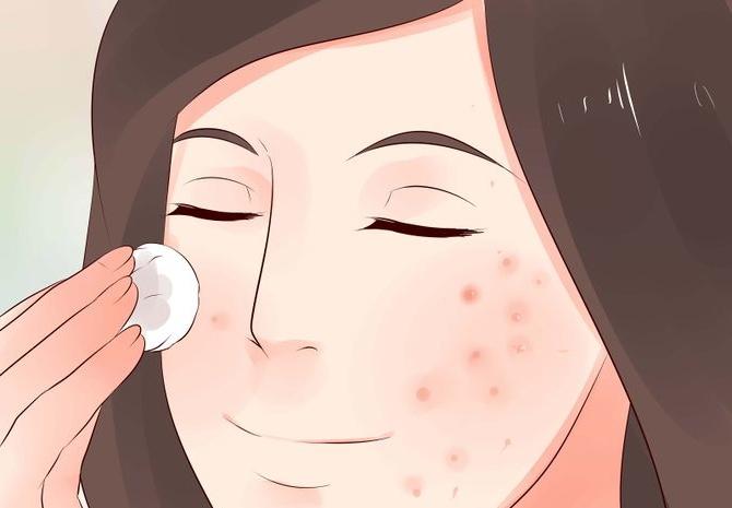 come rimuovere l'acne arrossamento