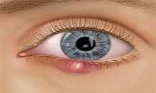 jak odstranit nádor z očí ječmene
