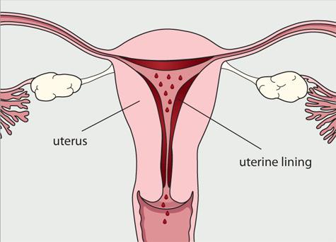 jak zatrzymać krwawienie podczas menstruacji