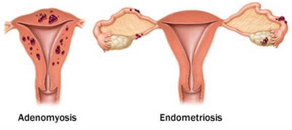 come fermare il sanguinamento uterino con iperplasia dell'endometrio